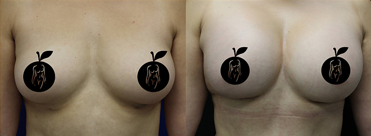 Breast Aug Before and After