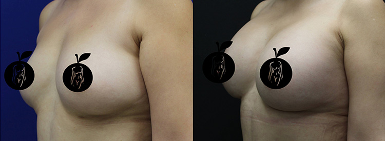 Breast Aug Before and After 2